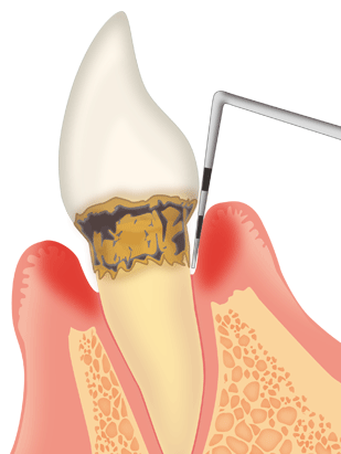 歯周ポケットが深くなっていませんか？