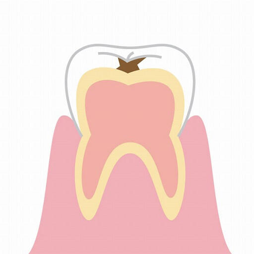 エナメル質が溶けた虫歯