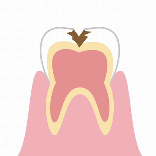 象牙質に到達した虫歯