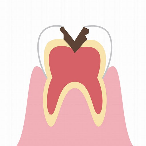 神経に到達した虫歯