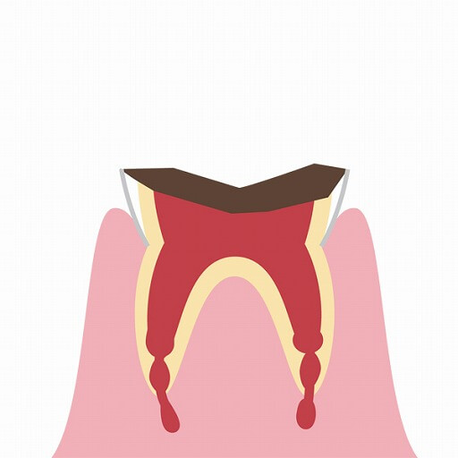 歯の根に到達した虫歯