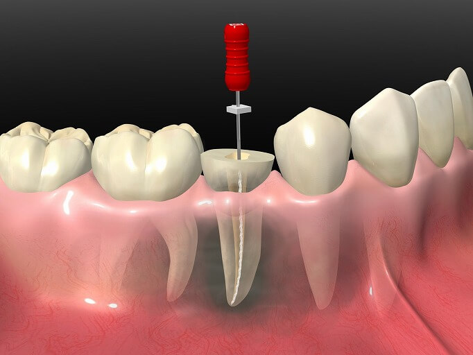 重度の虫歯の治療
