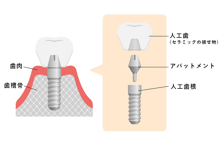 一次手術