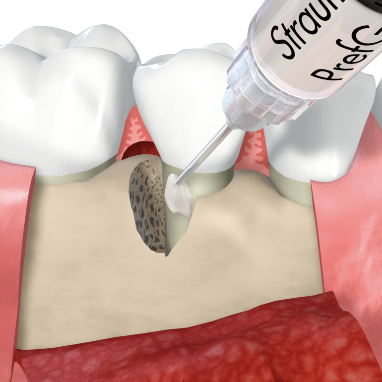 エムドゲインを使用した歯周組織再生療法
