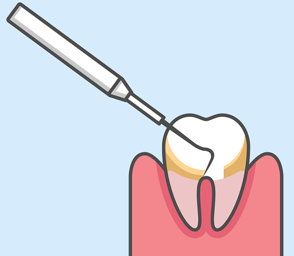 歯石除去(歯石取りの方法)
