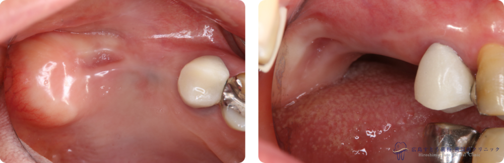 右上の抜歯後の状態：歯肉が陥凹してしまっています