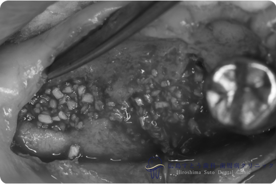 右下の手術中の状態：骨移植後