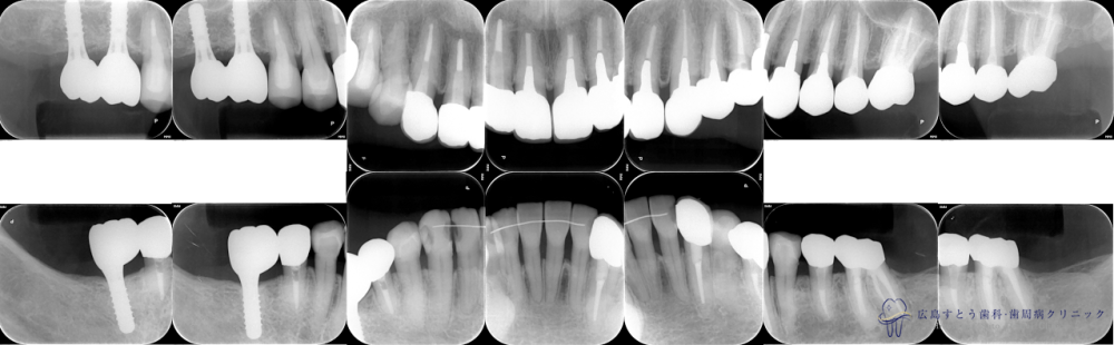 治療終了後のレントゲン写真