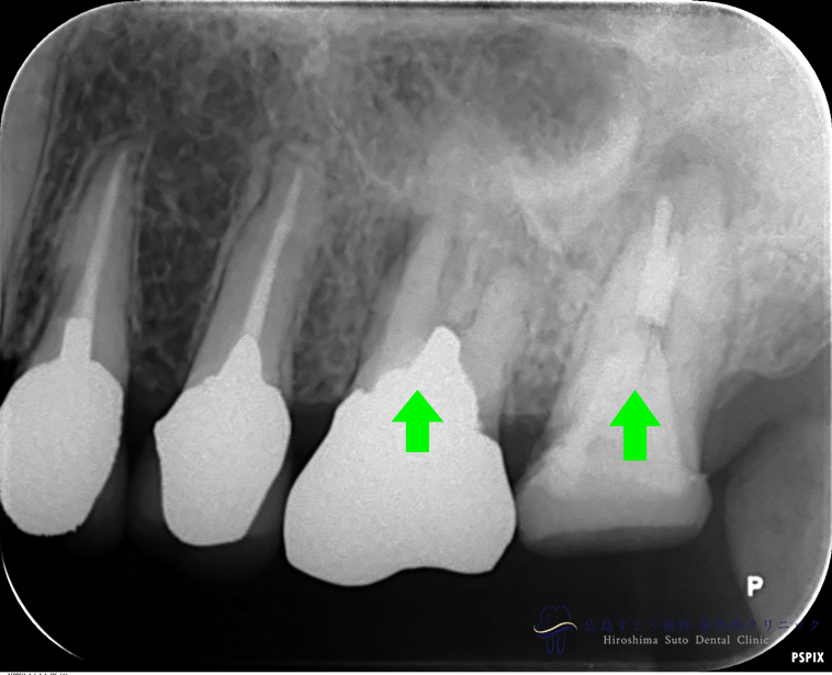 初診時：左上の第一、第二大臼歯は歯根が破折しており、抜歯することになりました。
