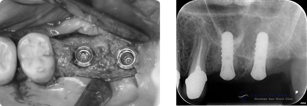 インプラント手術中